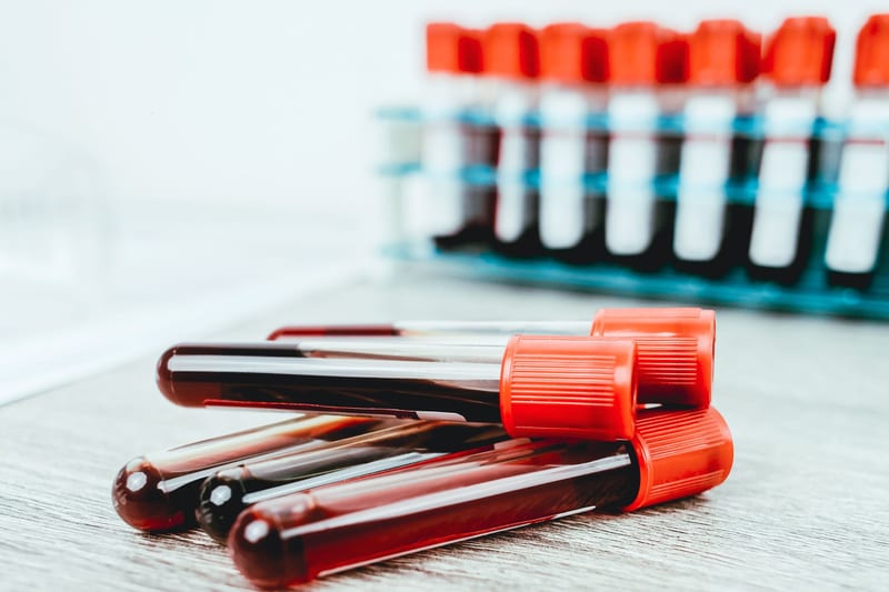 Hierro Intravenoso para la Anemia: Cuándo Está Indicado de Verdad
